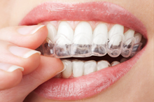 One hour teeth whitening is a revolutionary procedure that is safe, effective and fast
